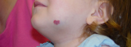 Os hemangiomas infantis, geralmente, crescem durante os doze primeiros meses de vida