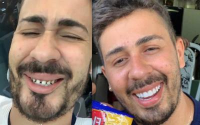 Antes e depois do sorriso de Carlinhos Maia 