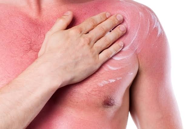 Peito com queimadura (insola��o)