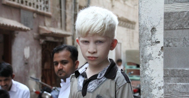 Existem diversos nveis de albinismo