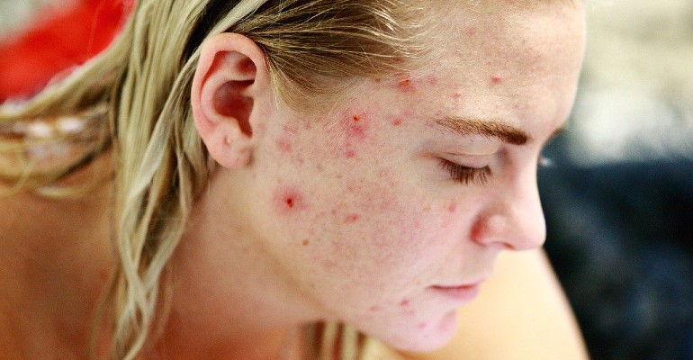A acne pode desencadear problemas psicolgicos